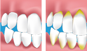 http://dentyss.com/wp-content/uploads/2019/09/Gencive.jpg