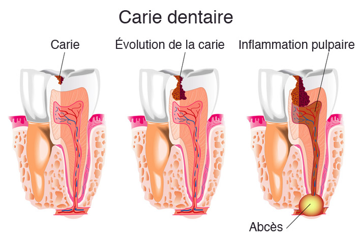 //dentyss.com/wp-content/uploads/2019/09/carie-dentaire.jpg