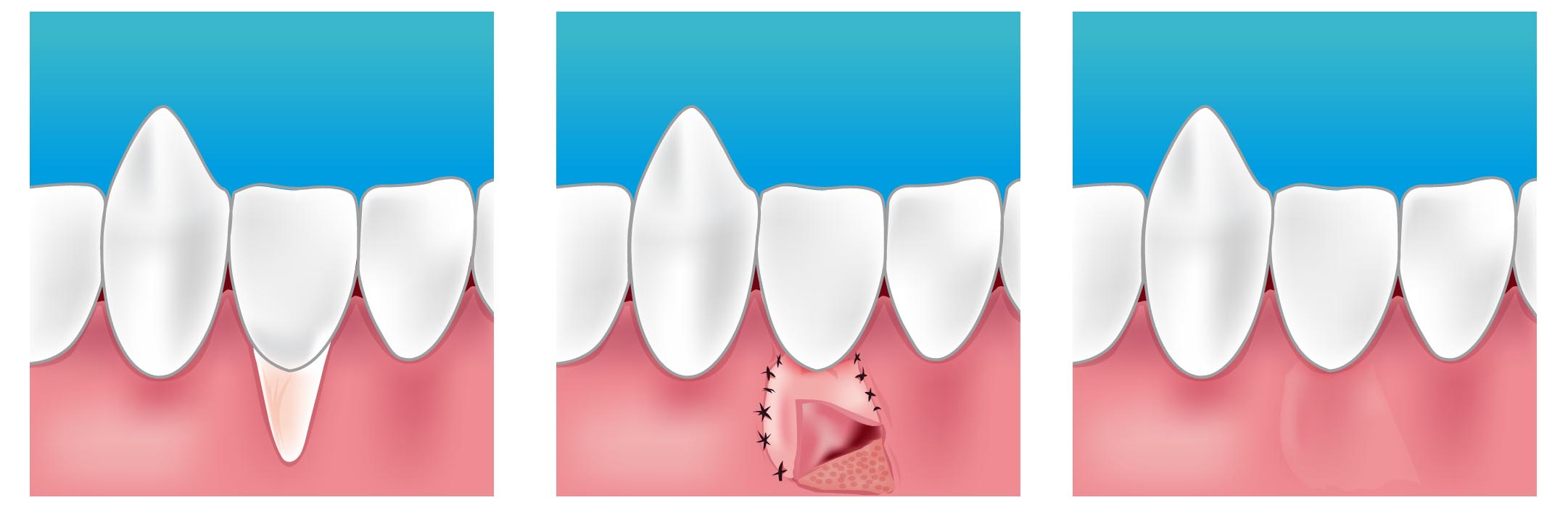 http://dentyss.com/wp-content/uploads/2019/09/greffe_gingivale.jpeg