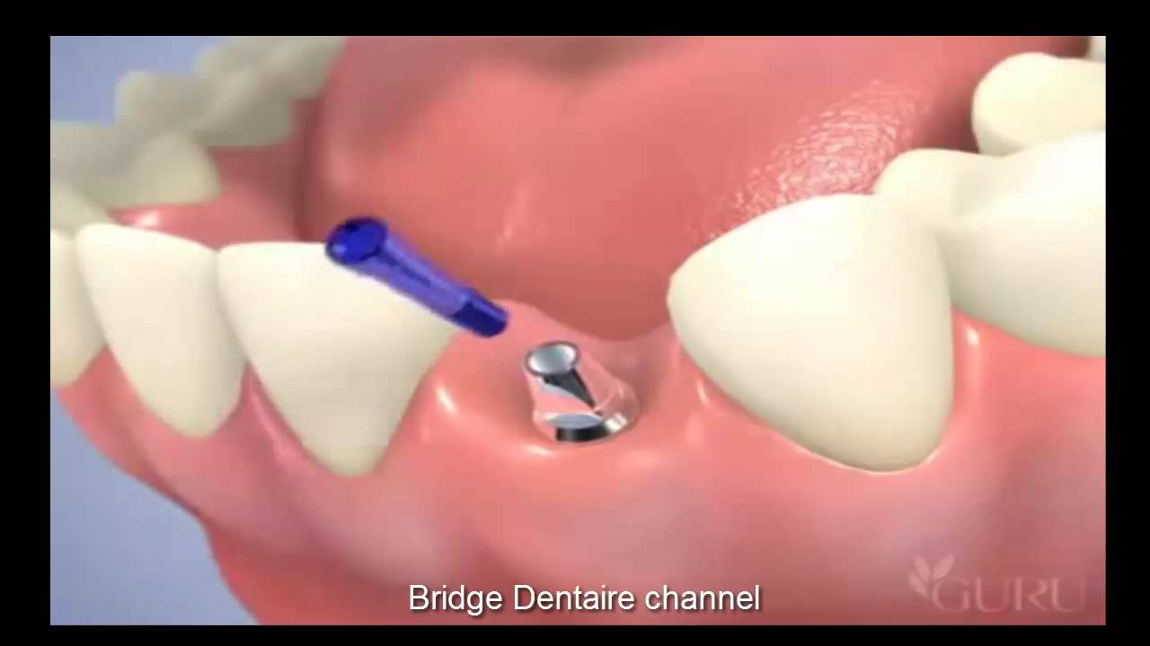 Atlanta-Dental-Trust-After-01